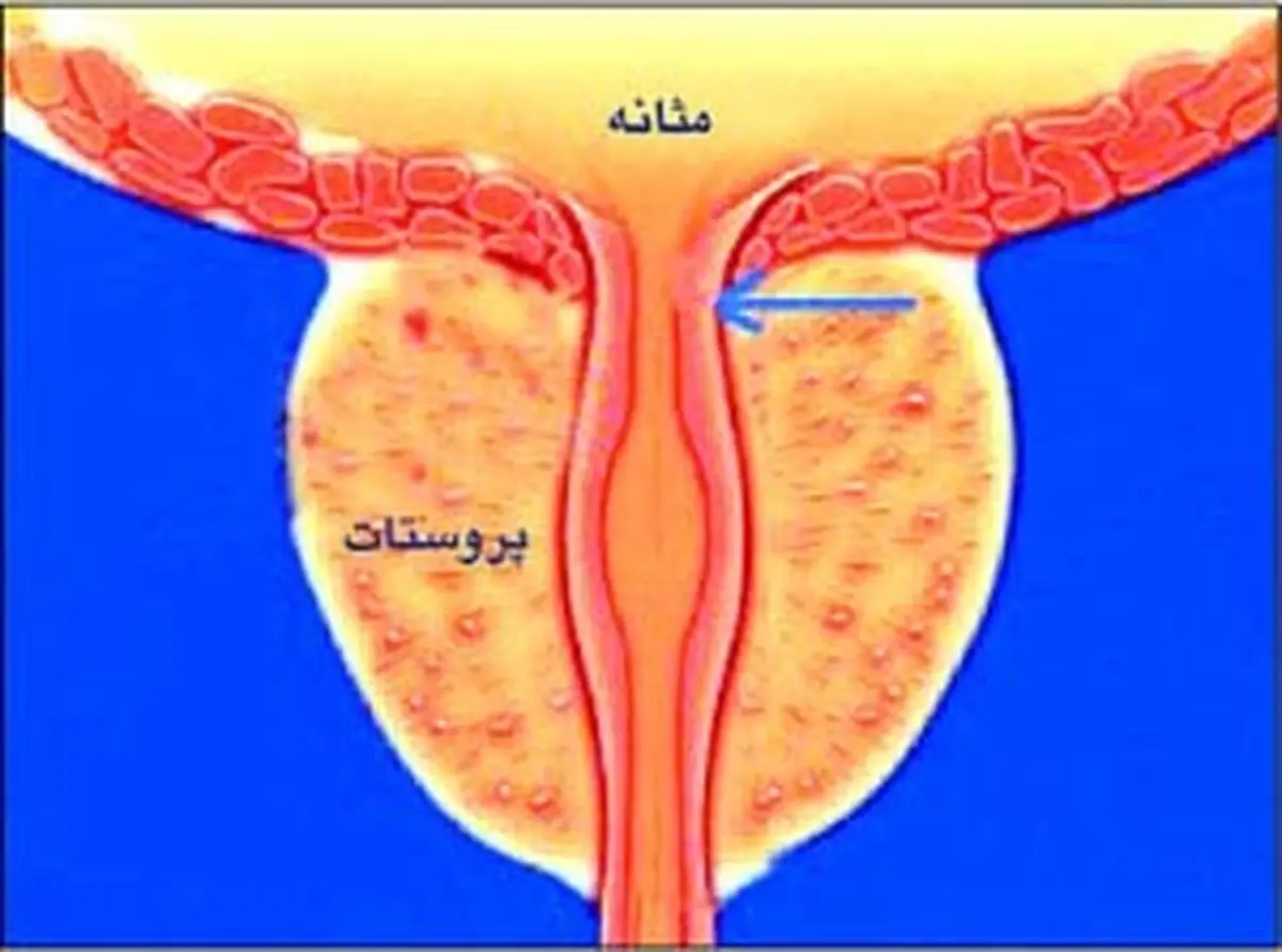 رابطه عجیب اندازه دور شکم آقایان و سرطان پروستات/ شکم گنده ها در خطر هستند!