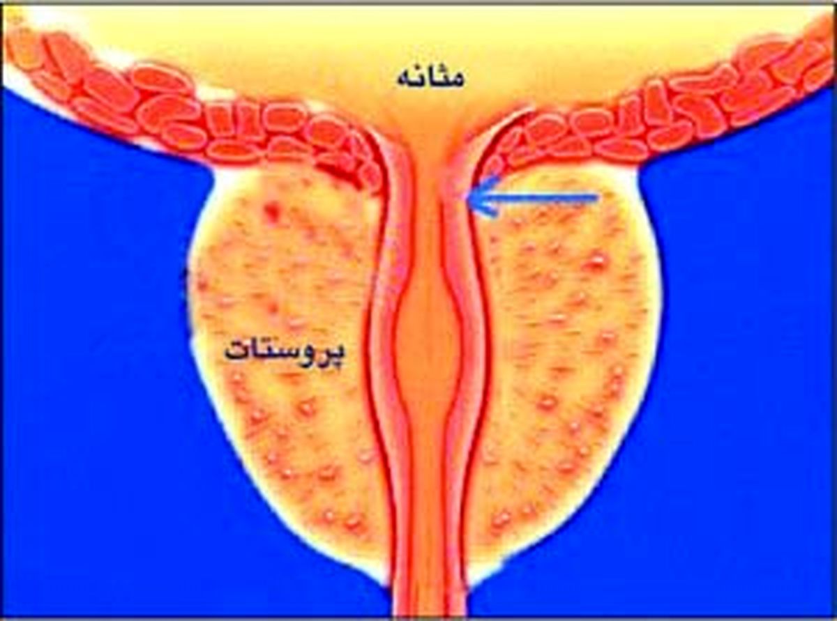 رابطه عجیب اندازه دور شکم آقایان و سرطان پروستات/ شکم گنده ها در خطر هستند!