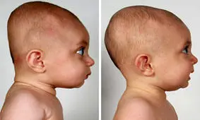 عدم تقارن سر نوزاد، آخه چرا؟