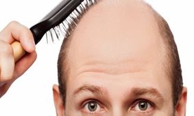 موفقیت محققان در کشف روشی برای درمان طاسی