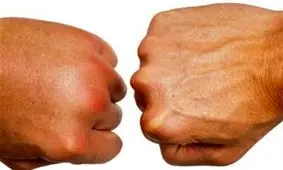 اگر دست‌هایتان باد می‌کند گوش بزنگ باشید