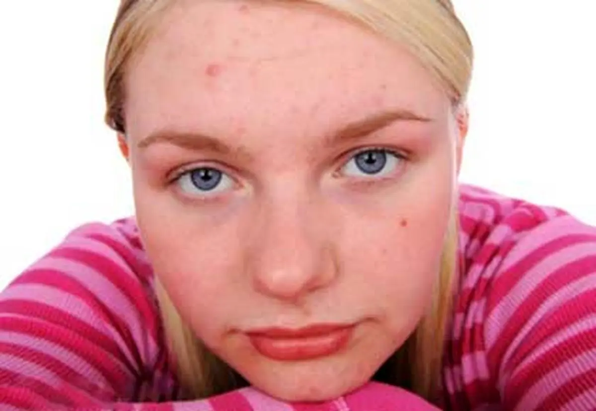 جوش ها دقیقا به ما چه می گویند ؟