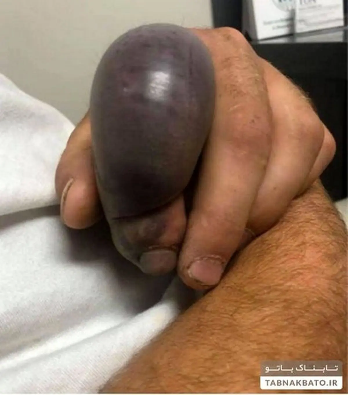 نیش مار، انگشت یک مرد را چند برابر کرد