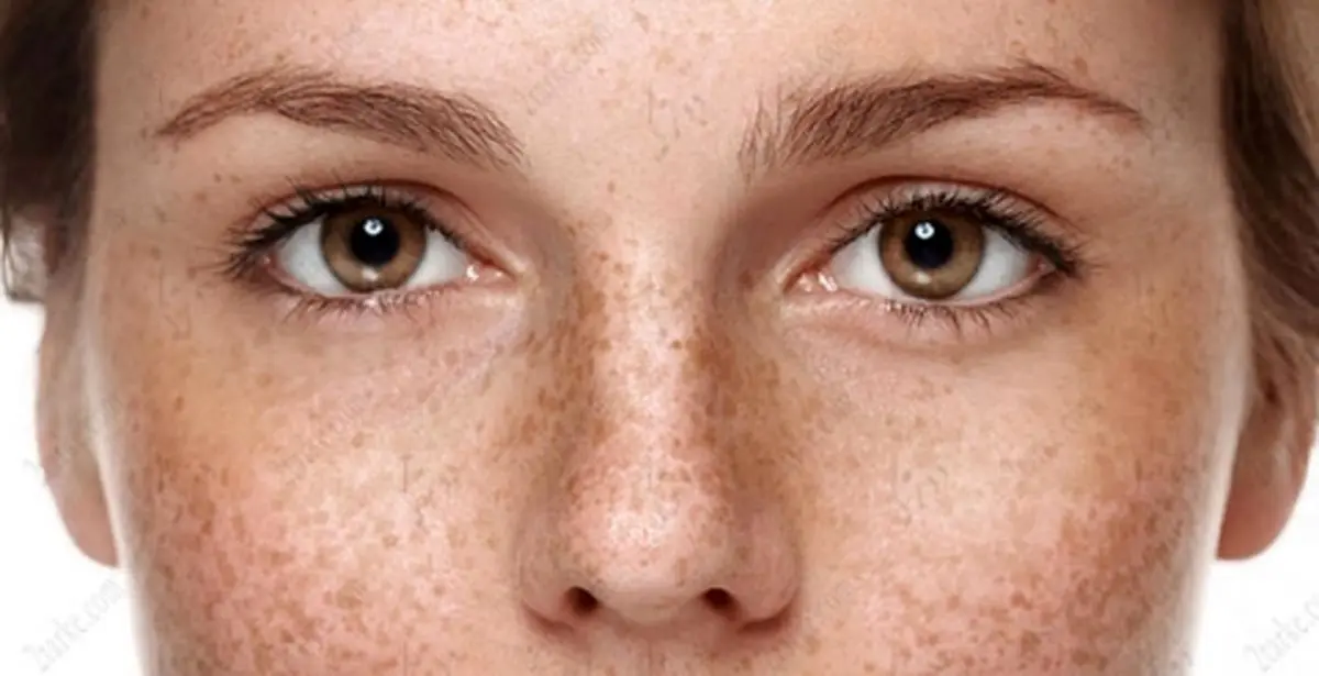 مشکلات پوستی در بارداری، شایع ترین ها