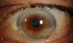 همه چیز درباره «آب مروارید»