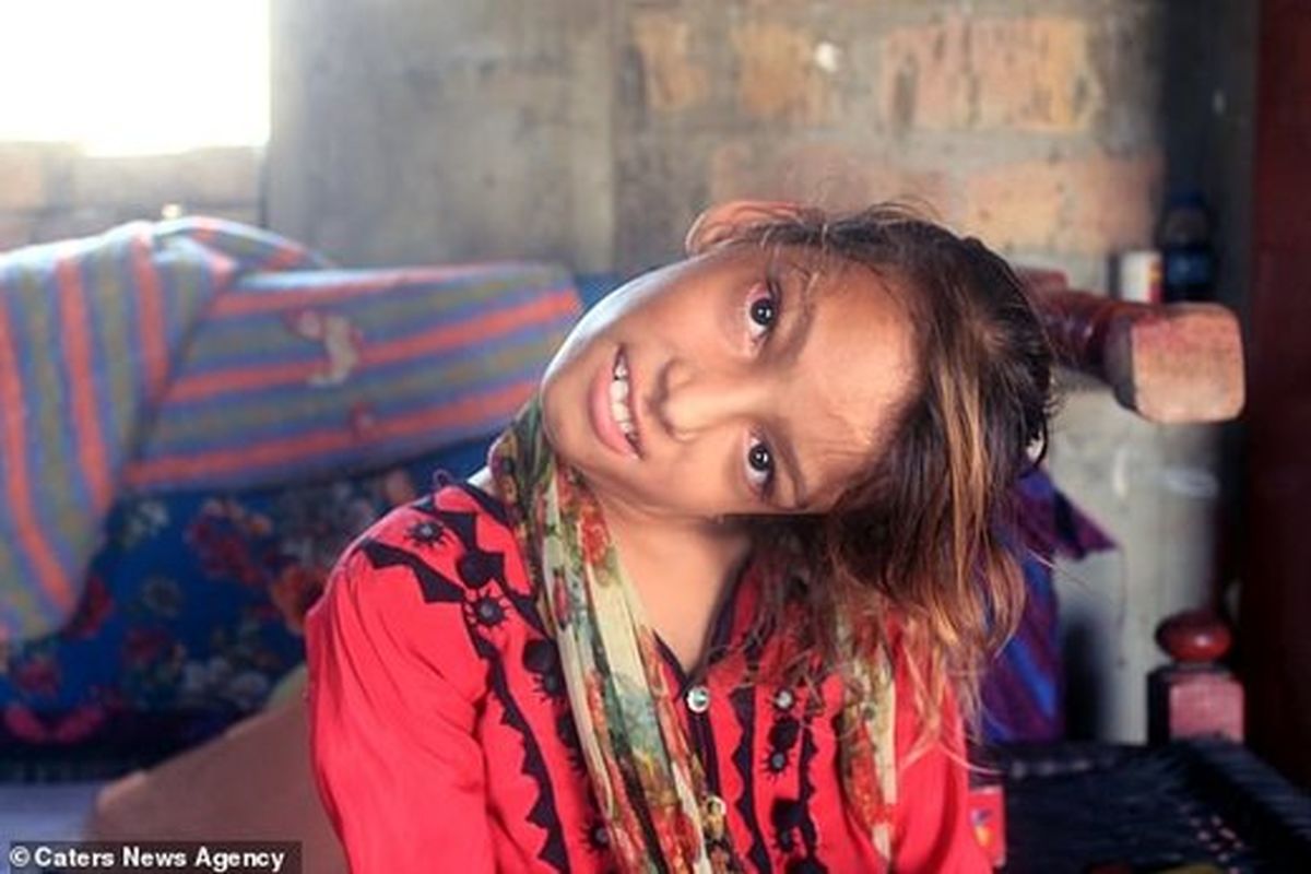 «کج گردنی» دختر پاکستانی+ تصاویر