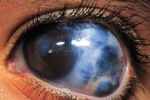 دومین عامل نابینایی در جهان را بشناسید!/راهکارهای مهم برای مقابله