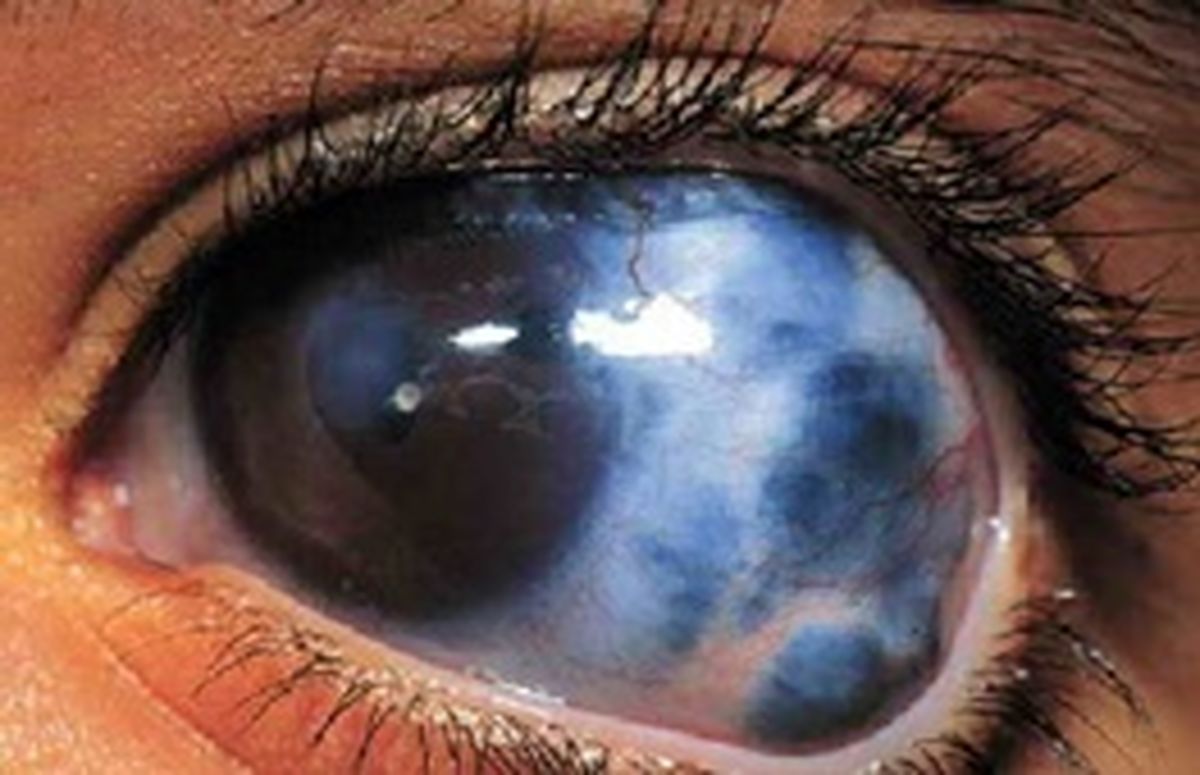 دومین عامل نابینایی در جهان را بشناسید!/راهکارهای مهم برای مقابله