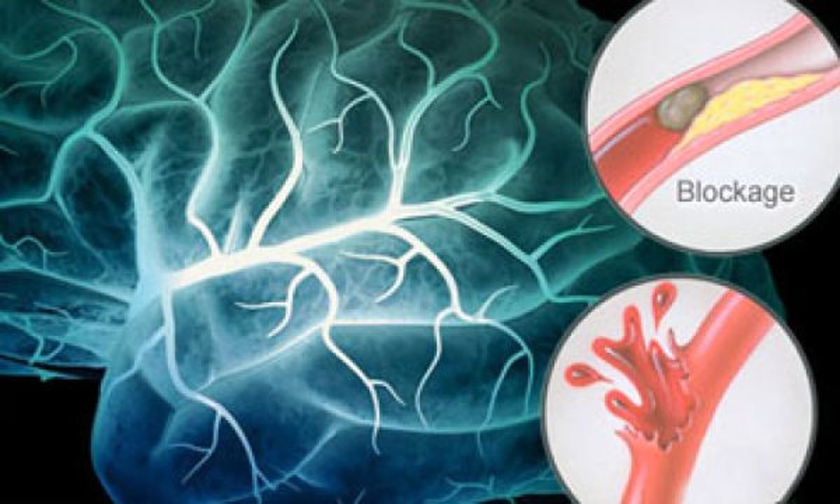 اينفوگرافي| آنچه در مورد سكته مغزى بايد بدانيم