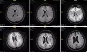در این اسکن ببینید کوکائین چه بلایی سر مغزتان می‌آورد / از فلج حرکتی و ضعف تکلم تا مرگ