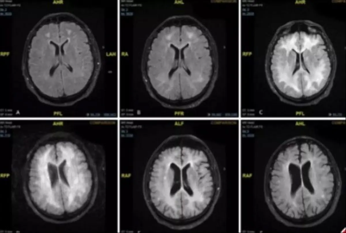 در این اسکن ببینید کوکائین چه بلایی سر مغزتان می‌آورد / از فلج حرکتی و ضعف تکلم تا مرگ