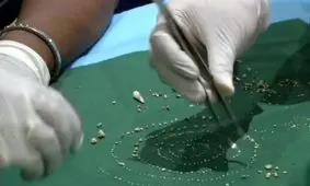 عجیب‌ترین رویداد دندانپزشکی سال 2019 / دندانپزشکان هندی 526 دندان اضافی را از دهان پسر هفت ساله خارج کردند