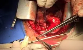 عمل باز جراحی قلب به زودی در ایلام انجام می شود