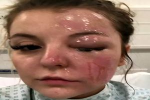 انفجار تخم‌مرغ پخته شده در مایکروویو یک دختر ۲۲ ساله را نابینا کرد