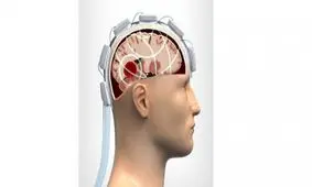 بررسی آسیب‌های سر با کلاه امواج مایکروویو