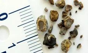 رهایی از سنگ کلیه با نسخه‌های طبیعی + پرهیزهای غذایی/ قوی‌ترین سنگ‌شکن‌های گیاهی