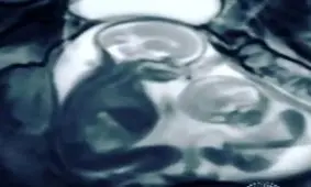 فیلم| کتک‌کاری عجیب دوقلوها در رحم مادر