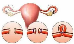 بستن لوله رحم در زنان، مزایا و معایب