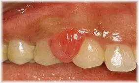 تومور حاملگی چیست؟