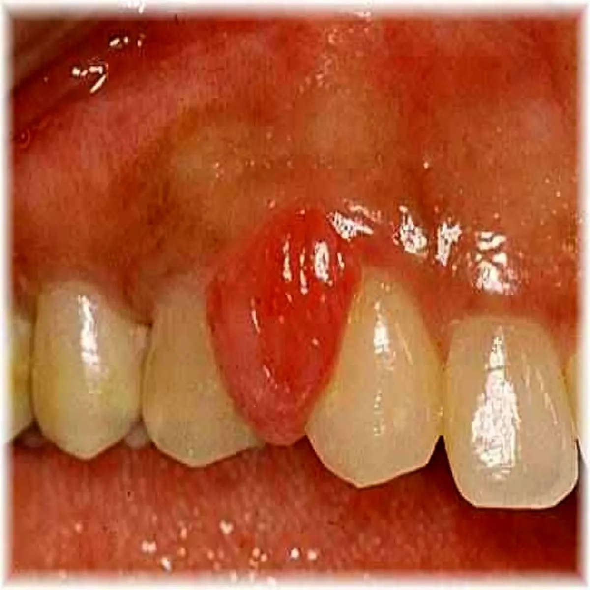 تومور حاملگی چیست؟