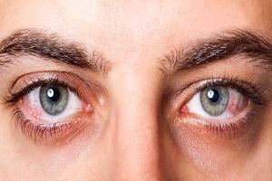 بیماری چشمی که بینایی شما را نشانه می‌رود + علائم و درمان التهاب عنبیه