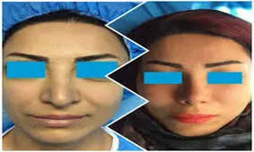 واکنش خانواده دختری که بعد از عمل بینی درگذشت