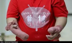 تلفات جانی چهارشنبه سوری تهران تا ساعت ۲۲ امشب ۲ نفر و قطع ۴ اندام