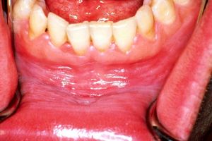 تولید چسب مخاطی کورکومین برای درمان ضایعات زخمی لیکن‌پلان دهانی