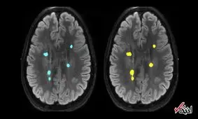 پژوهشگران استرالیایی از هوش مصنوعی برای تحلیل سریع اسکن مغز استفاده می کنند