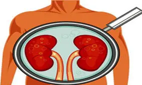 سیگار احتمال ابتلا به سرطان کلیه را 3 برابر افزایش می دهد