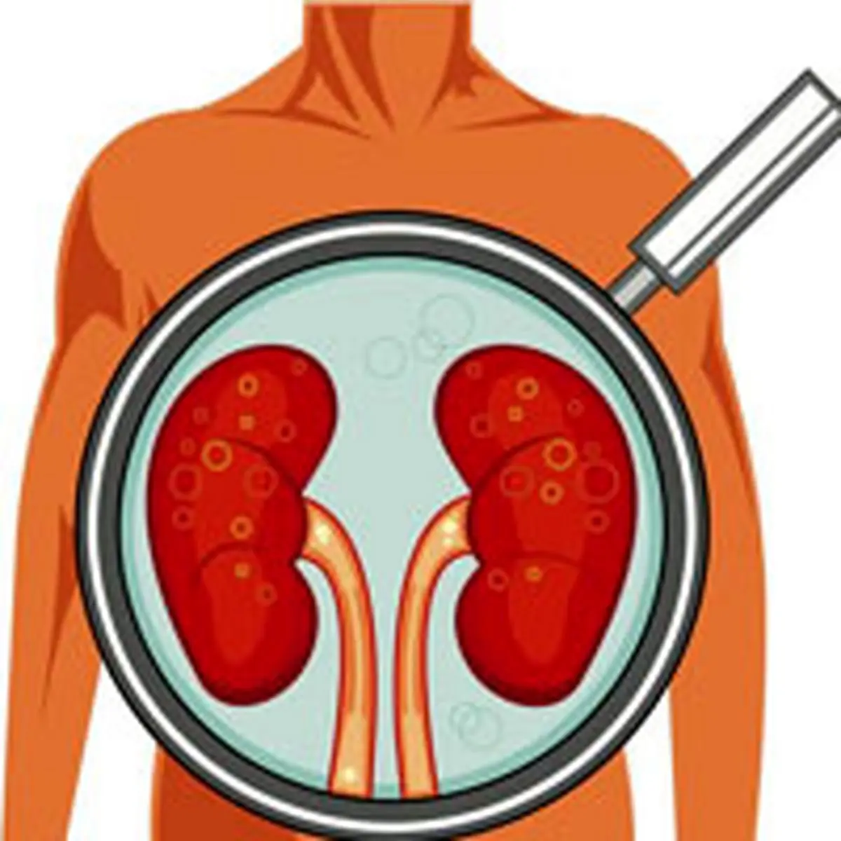 سیگار احتمال ابتلا به سرطان کلیه را 3 برابر افزایش می دهد