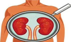 سیگار احتمال ابتلا به سرطان کلیه را 3 برابر افزایش می دهد