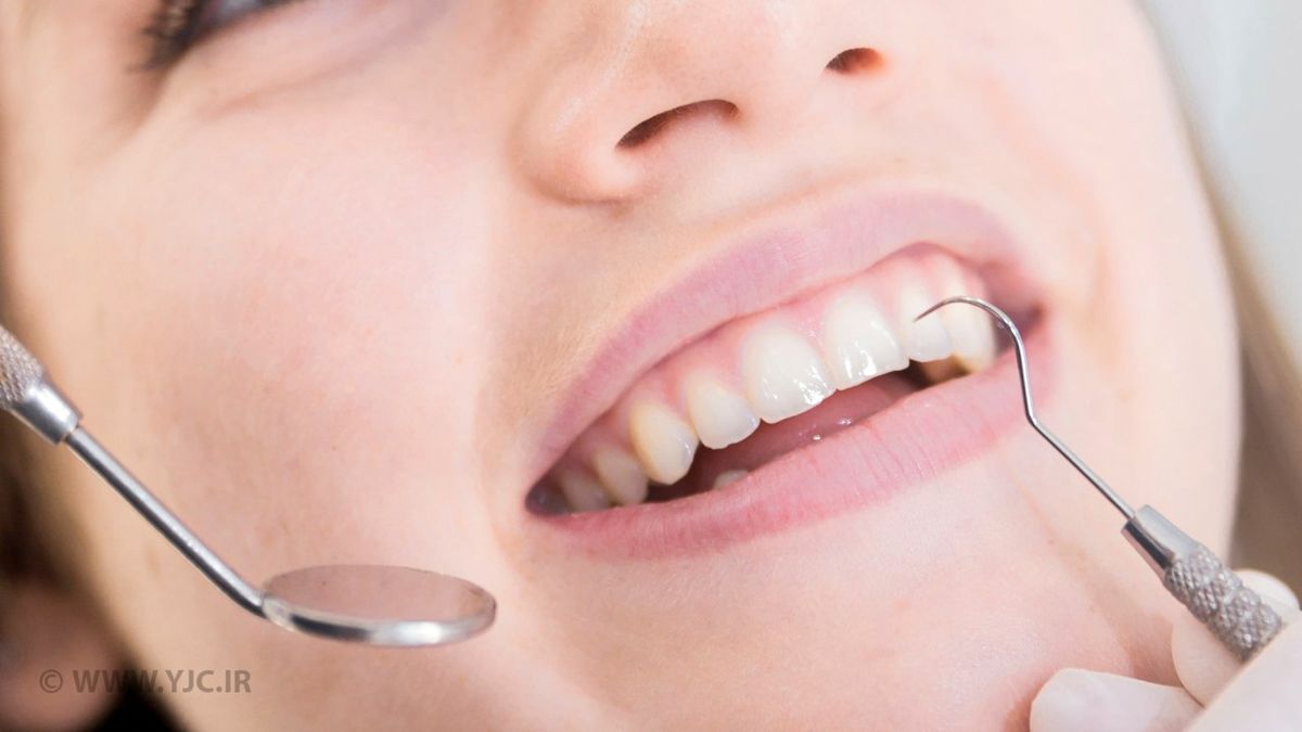 لمینت کردن دندانها، نیاز یا زیبایی؟ / طول عمر ونیرهای کامپوزیتی