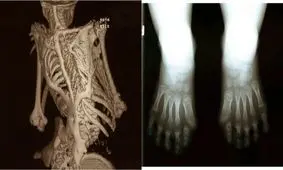 وحشتناکترین بیماری‌ها‌ی مرگ‌آور؛ از کرم چشم تا انسان سنگی و مرد فیلی