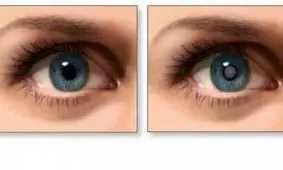 علائم خاموش آب‌مروارید؛ شاید شما هم دچارش باشید!