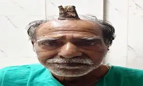 خارج کردن شاخ شیطان از سر مرد هندی