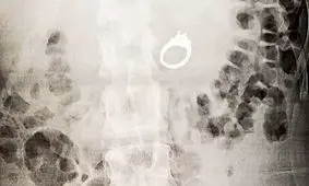 زن جوان حلقه نامزدی خود را در خواب بلعید! + عکس