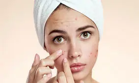 اگر جوش و آکنه می‌زنید، دور این کارها را خط بکشید!