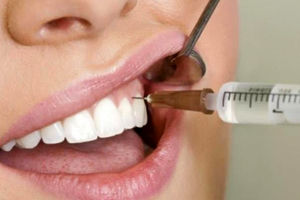 بهترین زمان برای کشیدن دندان عقل چه زمانی است؟