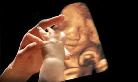 شناسایی ژن مرتبط با شکاف لب و کام