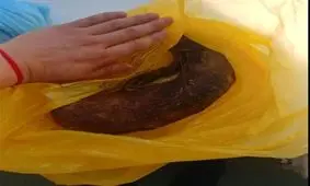 خارج کردن توده مو از شکم دختر 19 ساله