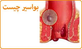  مهمترین عادات و علل ابتلا به بواسیر کدامند ؟