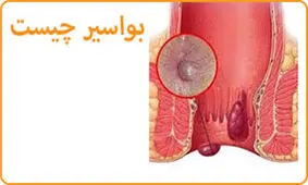  مهمترین عادات و علل ابتلا به بواسیر کدامند ؟