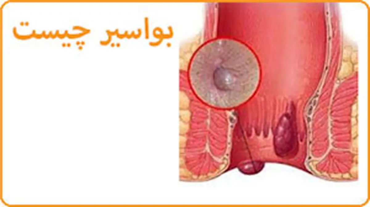  مهمترین عادات و علل ابتلا به بواسیر کدامند ؟