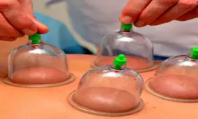 کاسبی مغازه‌های حجامت در فصل بهار/حجامت، درمان و پیشگیری نمی‌کند