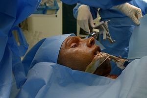 جراحی کاسه چشم برای اولین بار در ایران توسط دستگاهی پیشرفته