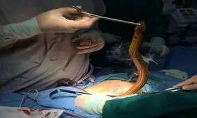 خارج کردن مار مرده از شکم یک زن + فیلم