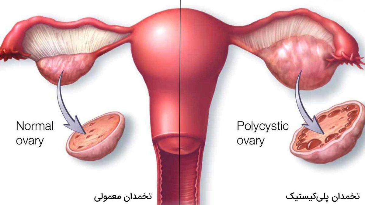 درمان سندروم تخمدان پلی‌کیستیک با طب سنتی