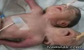 تولد نوزاد عجیب الخلقه با 2 سر و 3 دست