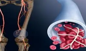 چگونه متوجه لخته خون در بدن شویم؟